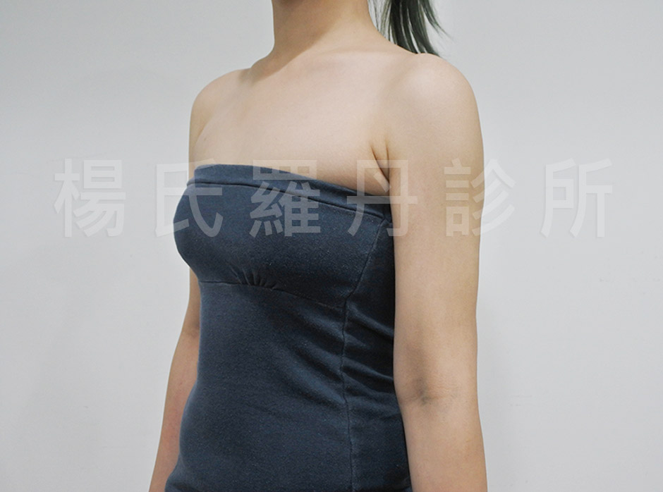 抽脂